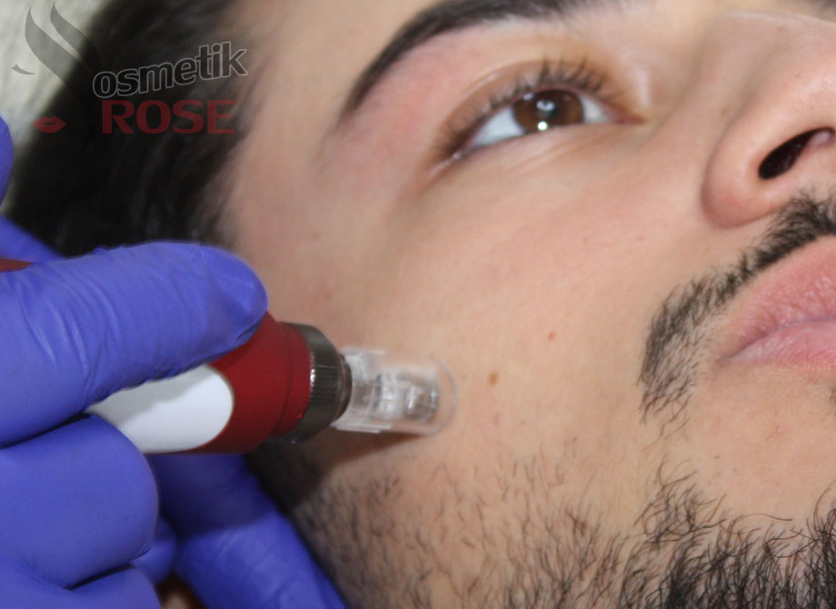 Micro Needling