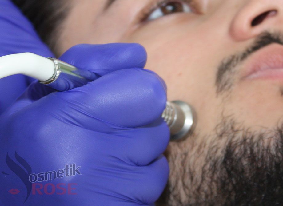 Mikrodermabrasion